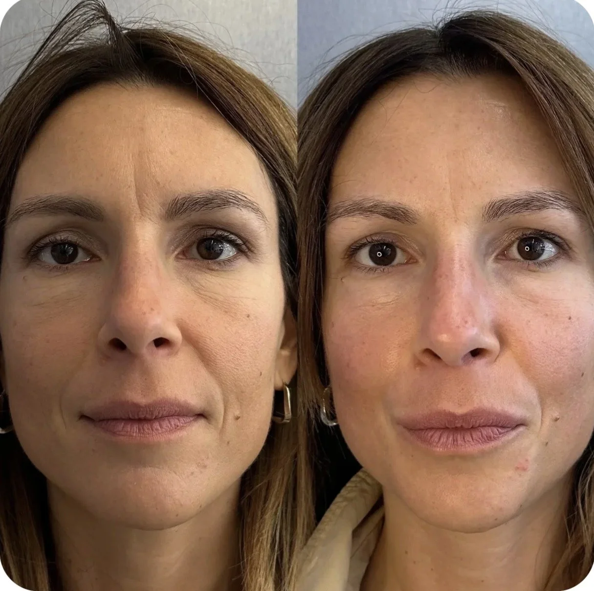 before after lift and glow facial at facestellar