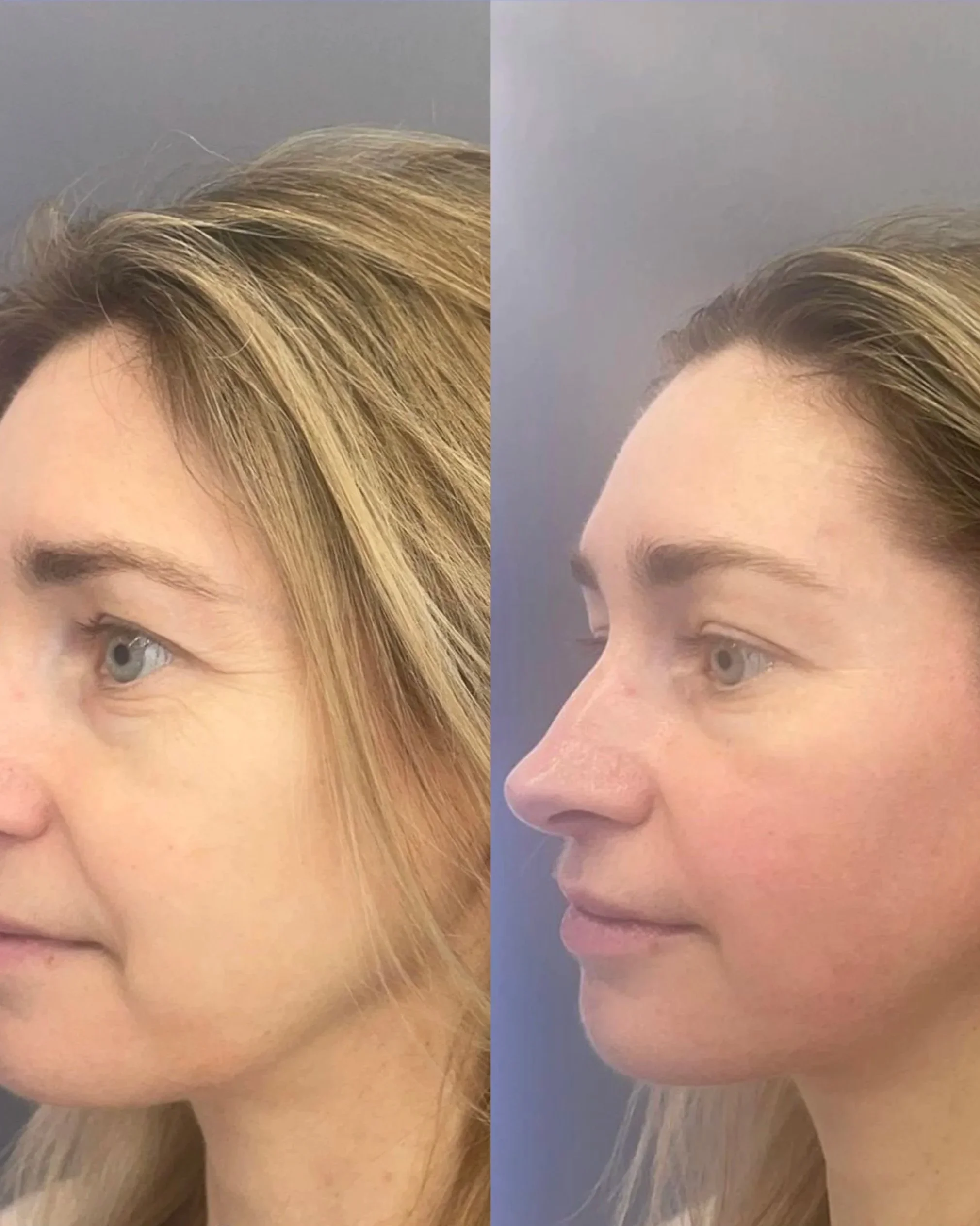 Side-by-side comparison of a woman's face before and after facial lymphatic drainage, showing improved skin smoothness and contour.