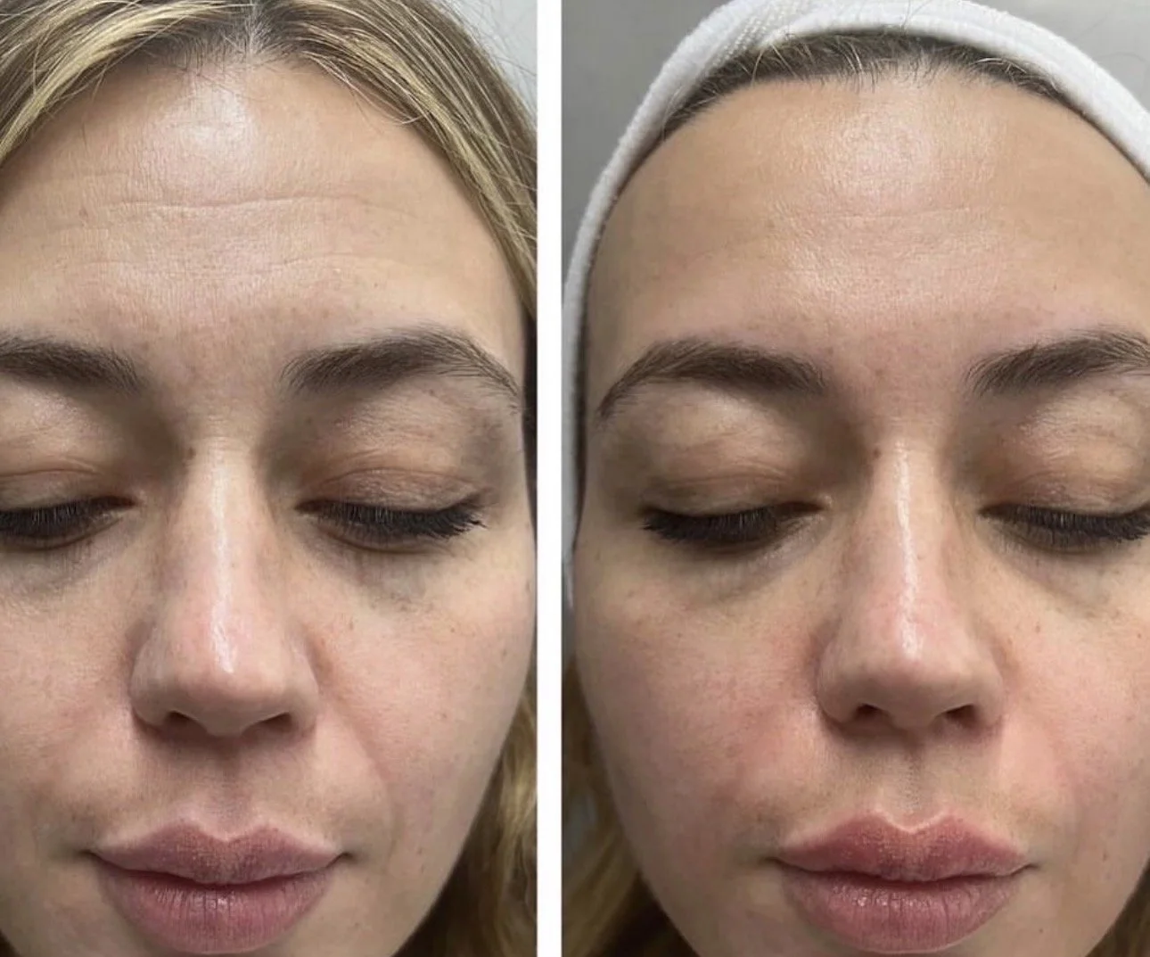 before after buccal facial 