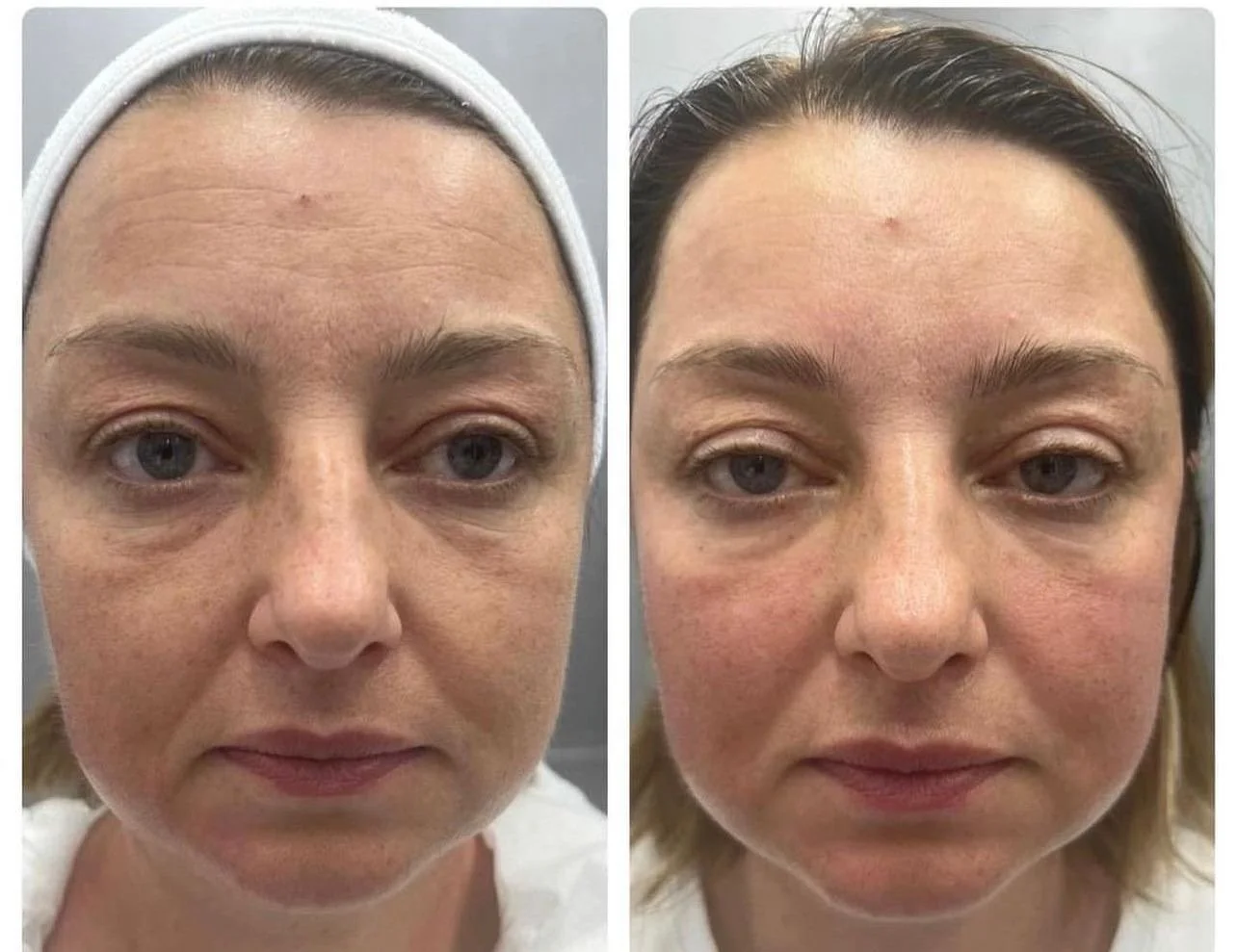 Close-up of skin after lymphatic drainage facial showing smoother texture, improved circulation and natural glow