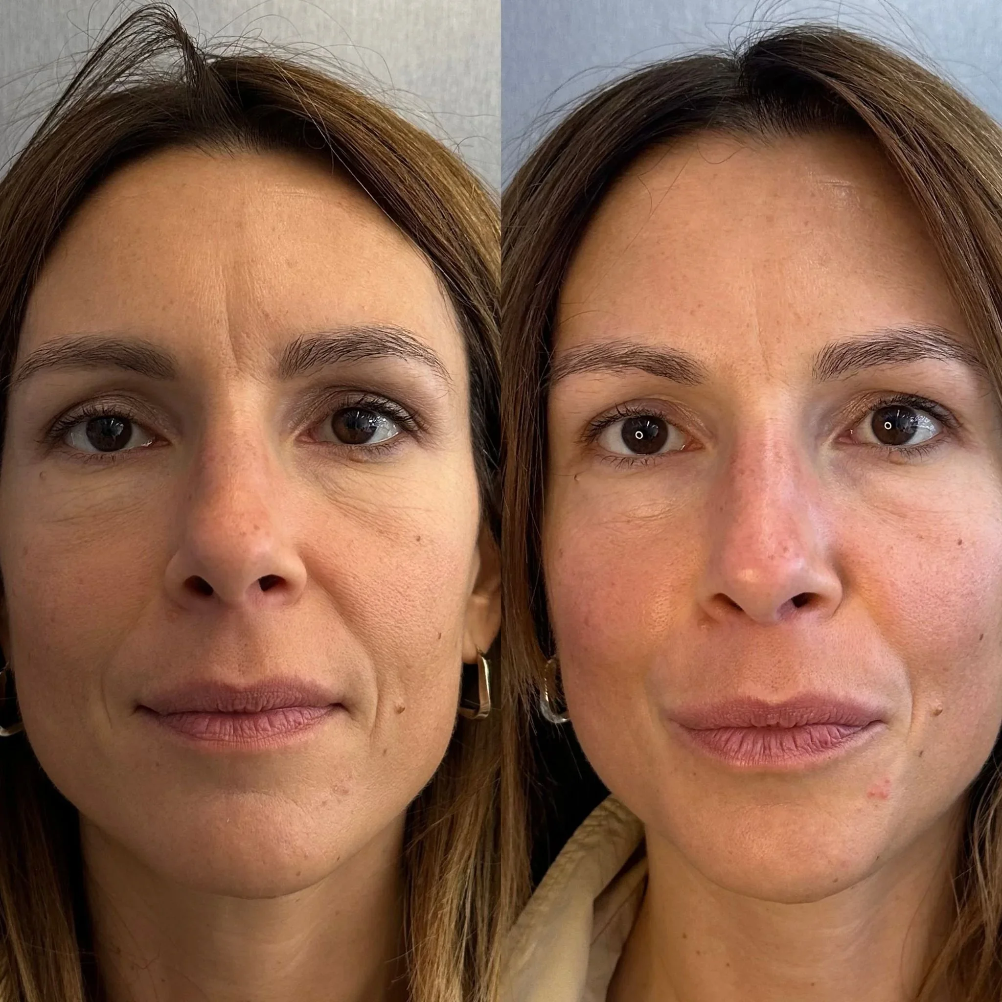 Before and after lifting and hydrating facial massage showing smoother skin, reduced fine lines and more defined facial contours