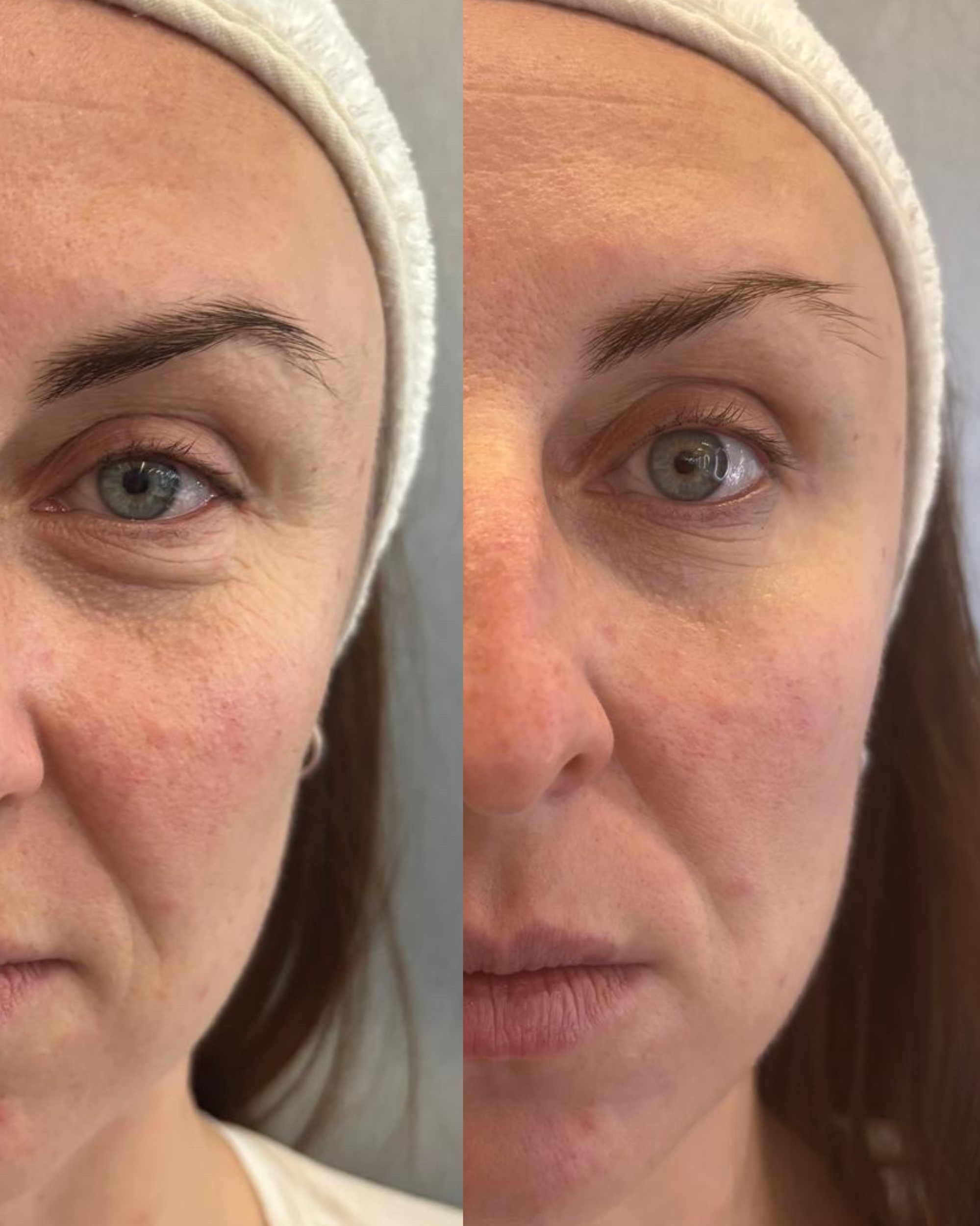 Before and after buccal facial showing lifted smile lines and reduced puffiness under eyes London