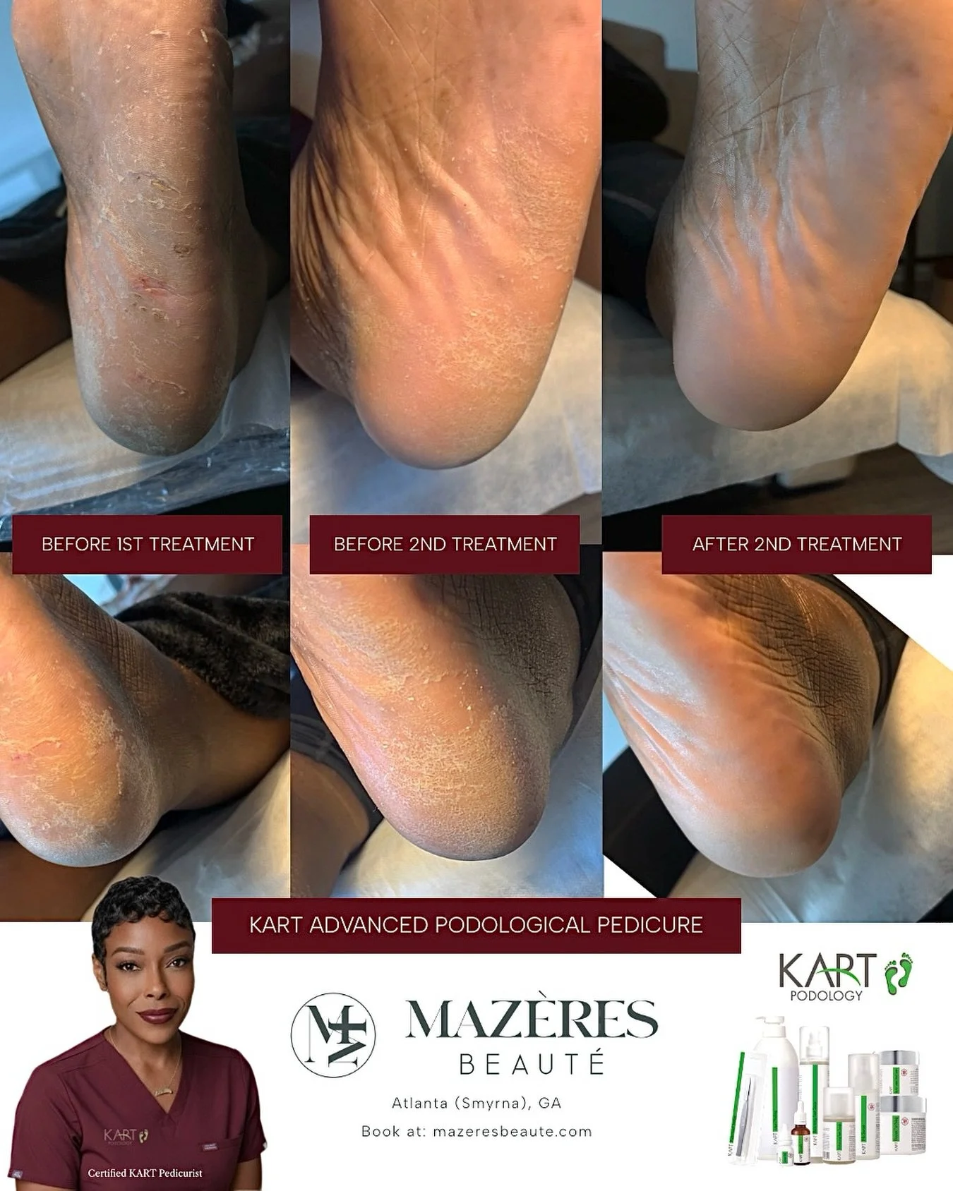 2 Sessions &bull; Real Results with KART Advance Podological Pedicure at Atlanta&rsquo;s Top European Salon

&bull;
&bull;
&bull;
&bull;
#russianmanicure #russianmaniatl #atlrussianmani #atlantarussianmanicure #drymanicure