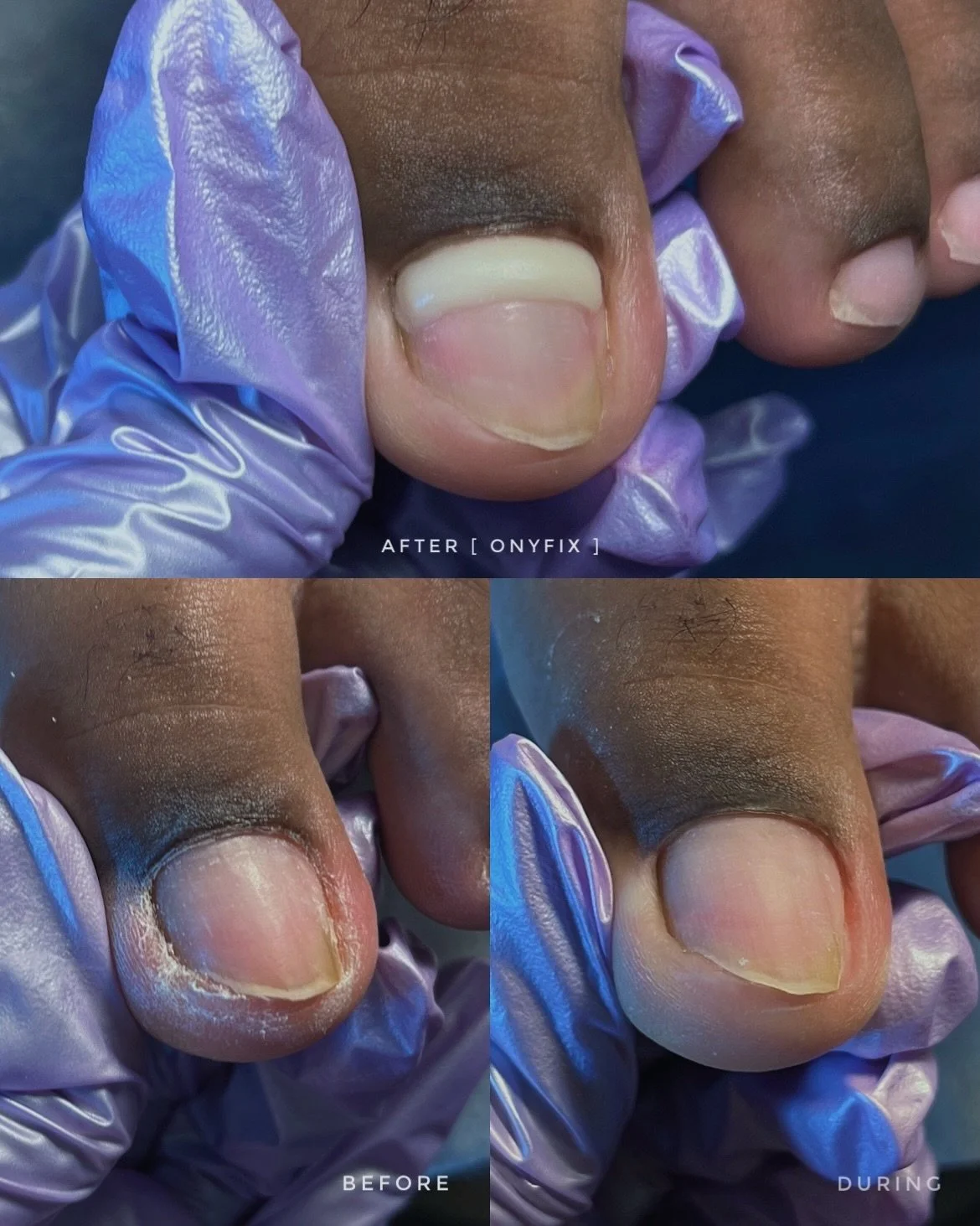 ONYFIX // This client came to us with chronic mild ingrown toenails on both halluxes specifically a nail spicule (a lateral nail spike) that was causing onychophosis, a buildup of thickened skin in the nail groove from repeated irritation.

Instead o