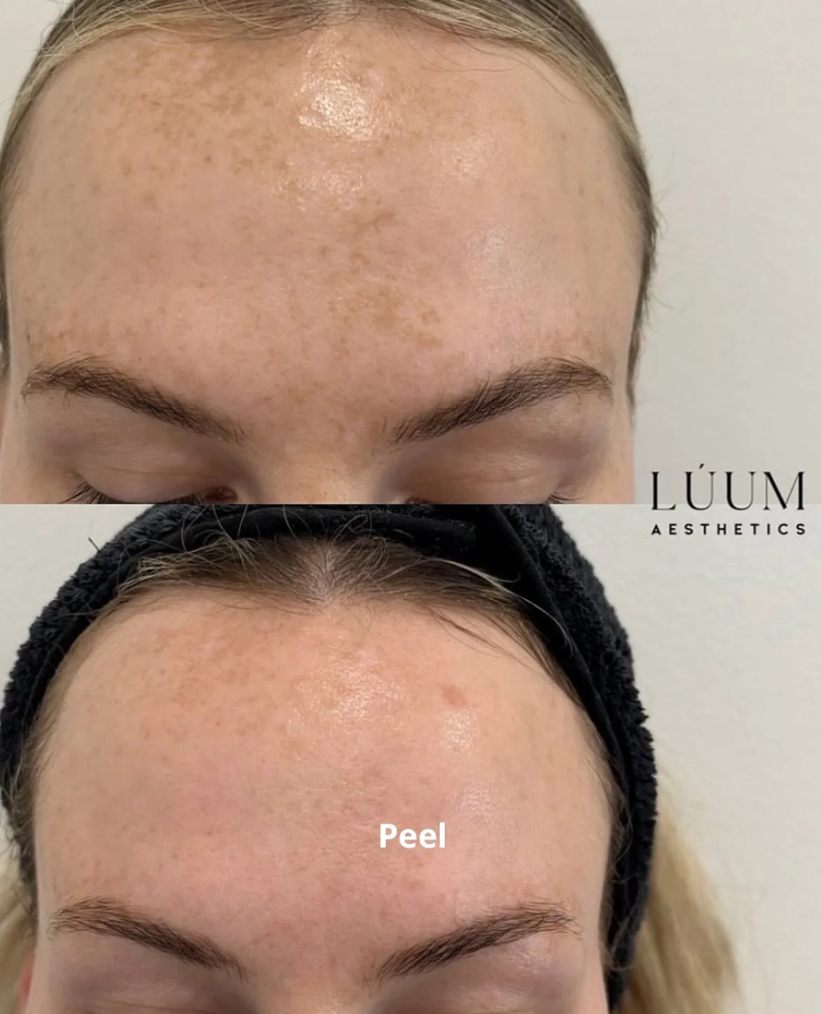 Skin Peel LUUM.jpg
