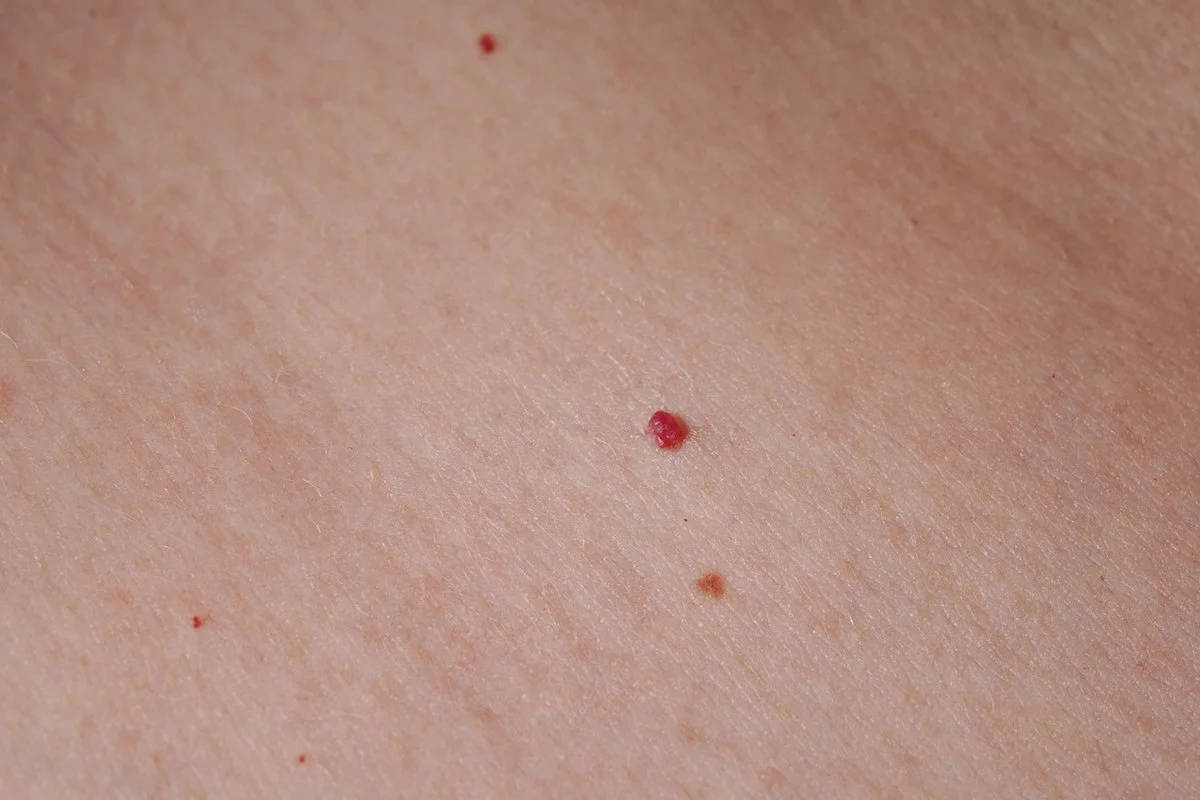What Is Diathermy for Skin Lesions?