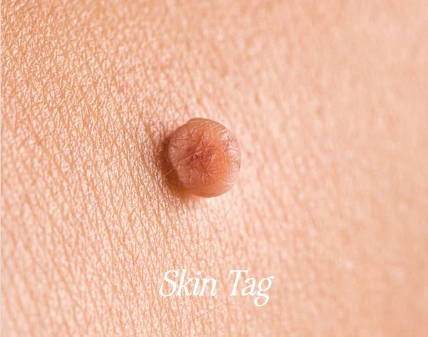 Skin Tags.jpg