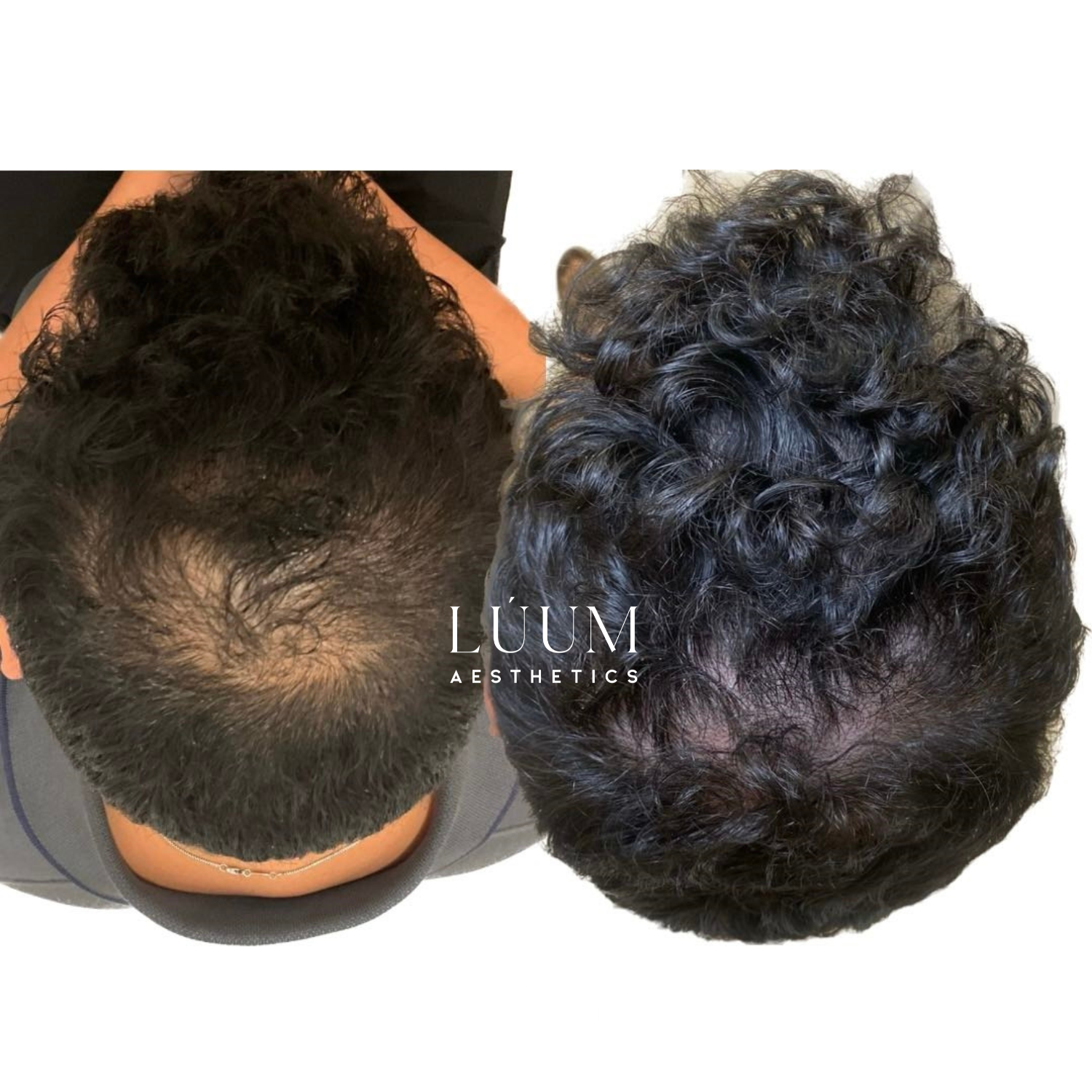 PRP Hair Growth