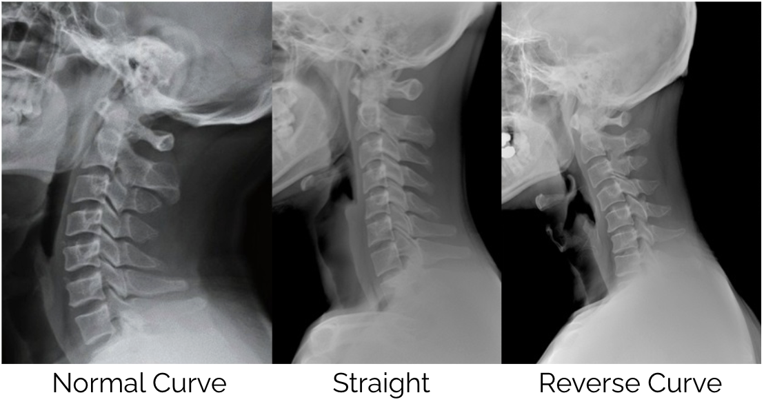 Tech Neck: What Your Screen Time Is Doing to Your Spine