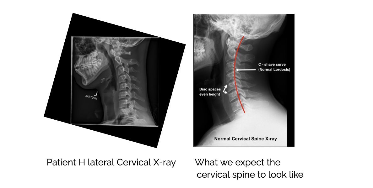 Tech Neck in Teenagers: Why It’s Rising and How Chiropractic Care Can Help