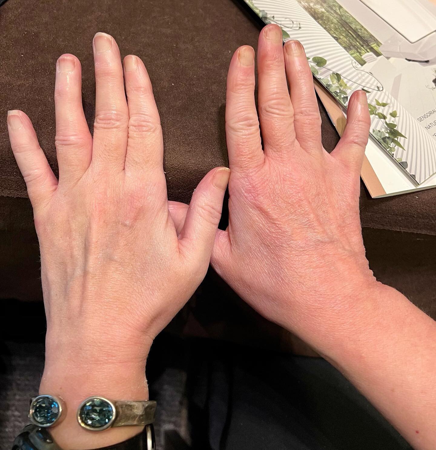 @sothysparis @sothysusa new Illuminating Facial for face, neck, d&eacute;collet&eacute; and hands!! Brighten the skin and lighten sun and age spots! These are my hands before and after. #brightening #aesthetician #sothys #nosunspots #antiaging #healt
