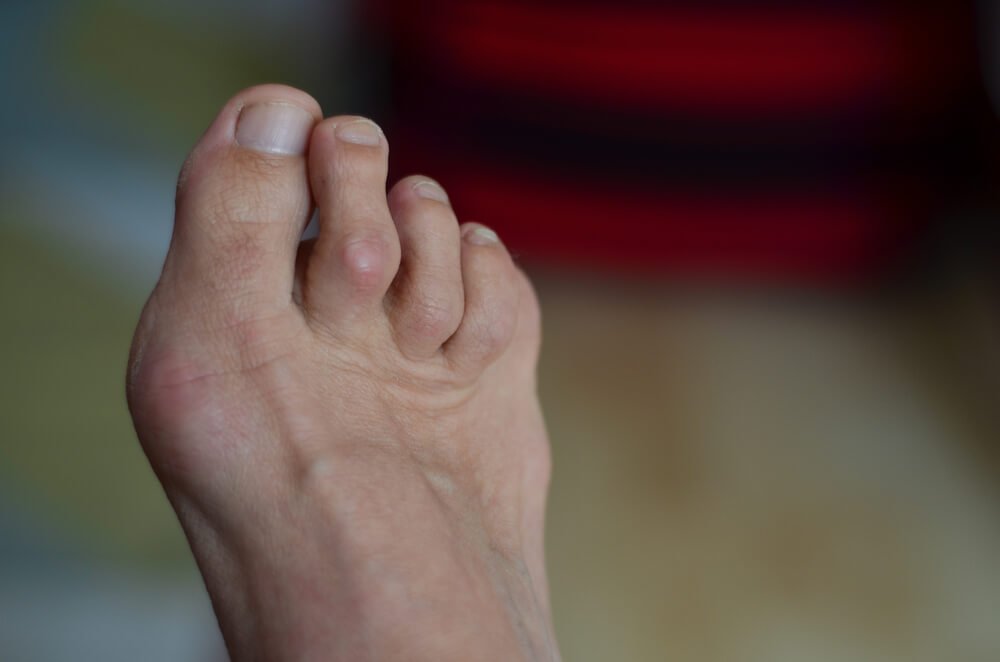 Hammer Toe Treatment — New York Foot Health, NYSPMA