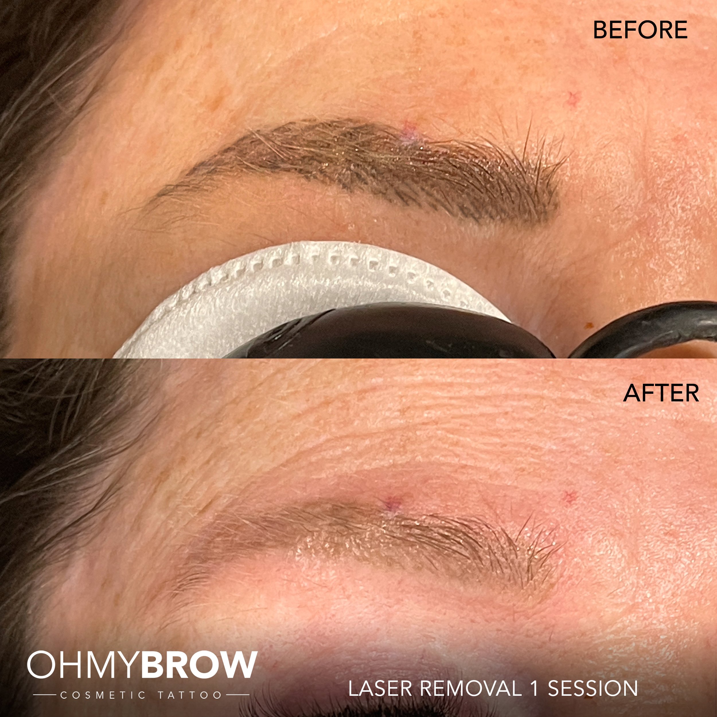 Aggregate more than 71 eyebrows tattoo removal latest - in.eteachers