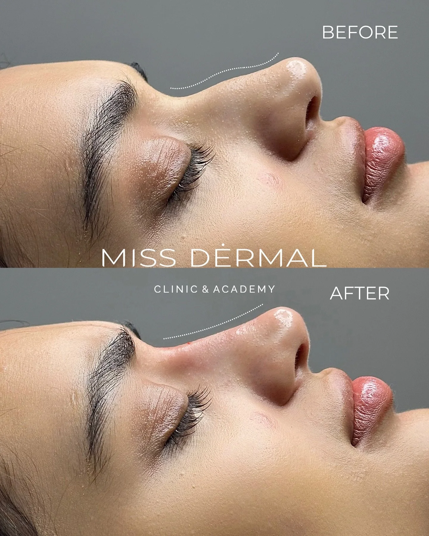 This beautiful transformation shows the power of non-surgical aesthetics✨

Using a small amount of hyaluronic acid dermal filler, we&rsquo;ve:
✔️ Straightened the nose bridge
✔️ Added a gentle lift to the nasal tip
✔️ Created a more balanced, harmoni