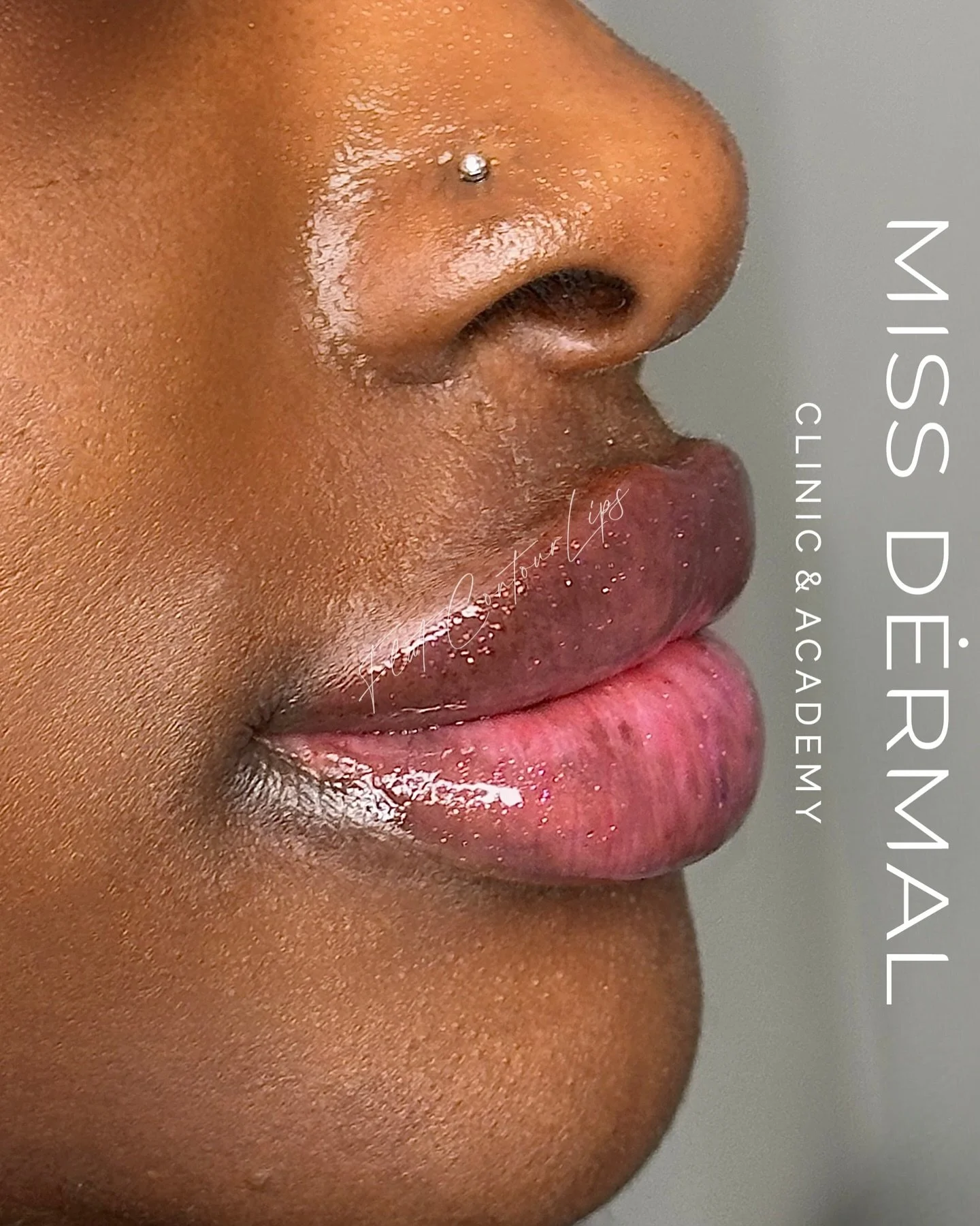 Let&rsquo;s be honest &mdash; not all lip filler is the same&hellip;

At Miss Dermal, you&rsquo;re not getting a rushed appointment or a copy-paste shape. You&rsquo;re getting one of the most refined techniques in Manchester &mdash; created by someon