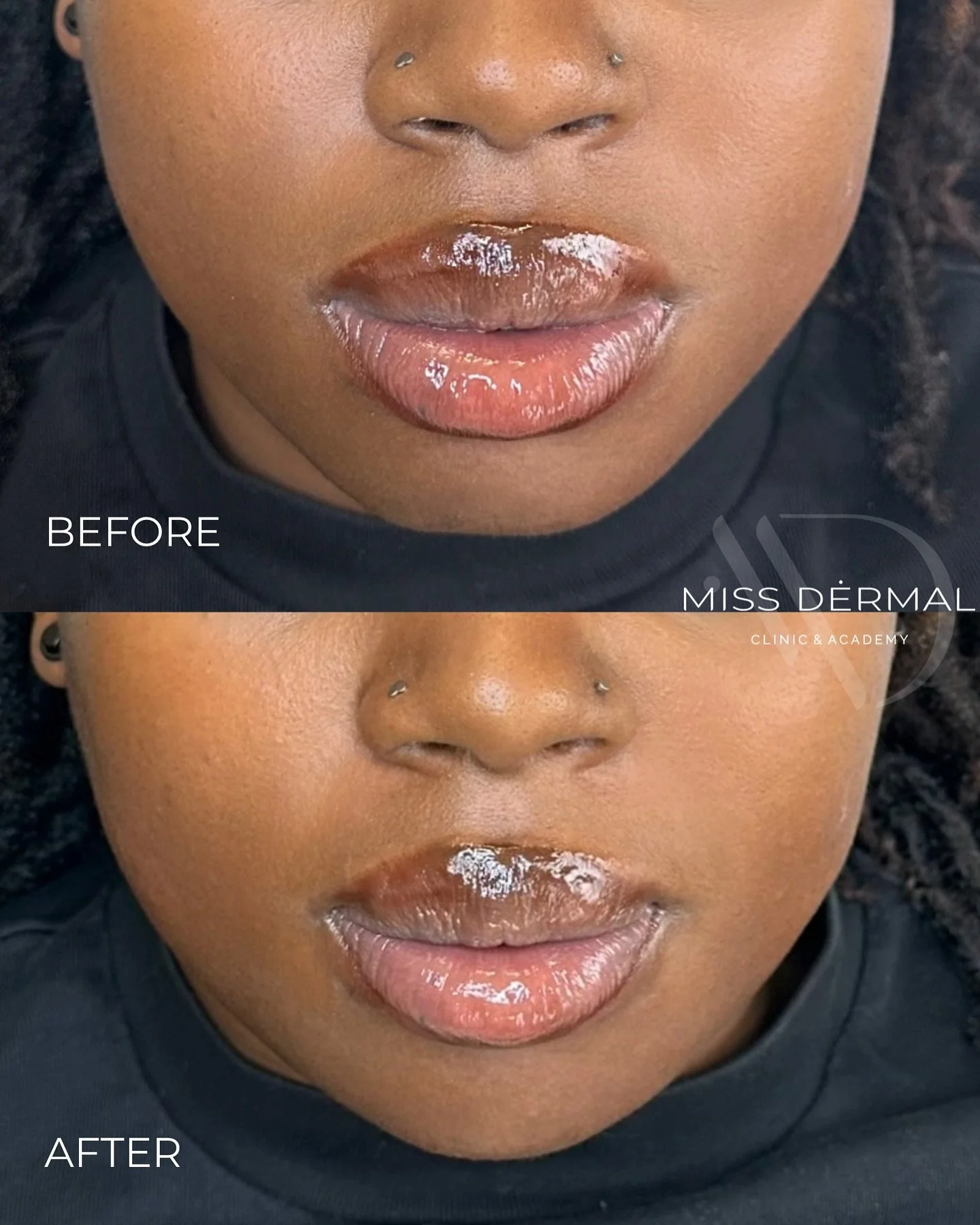 This beautiful result was achieved with just 1ml of chin filler to enhance a naturally flat and under-projected chin.

The goal was simple: to create harmony. A subtle projection that brings balance to the profile and a natural, softly rounded finish