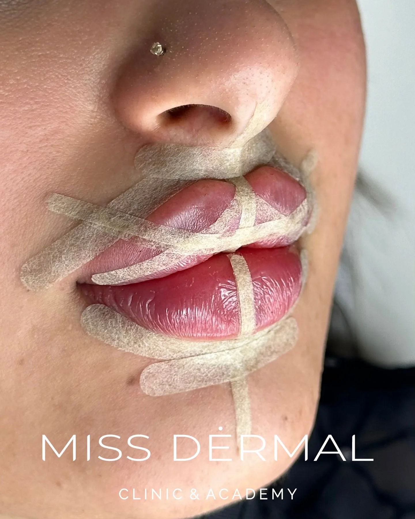 Lip Shape Transformation with Fusion Technique💉

My lovely client came to me wanting to alter her lip shape. She had previously had Russian Lips with me &ndash; and there was absolutely nothing wrong with them &ndash; but to meet her new vision, we 