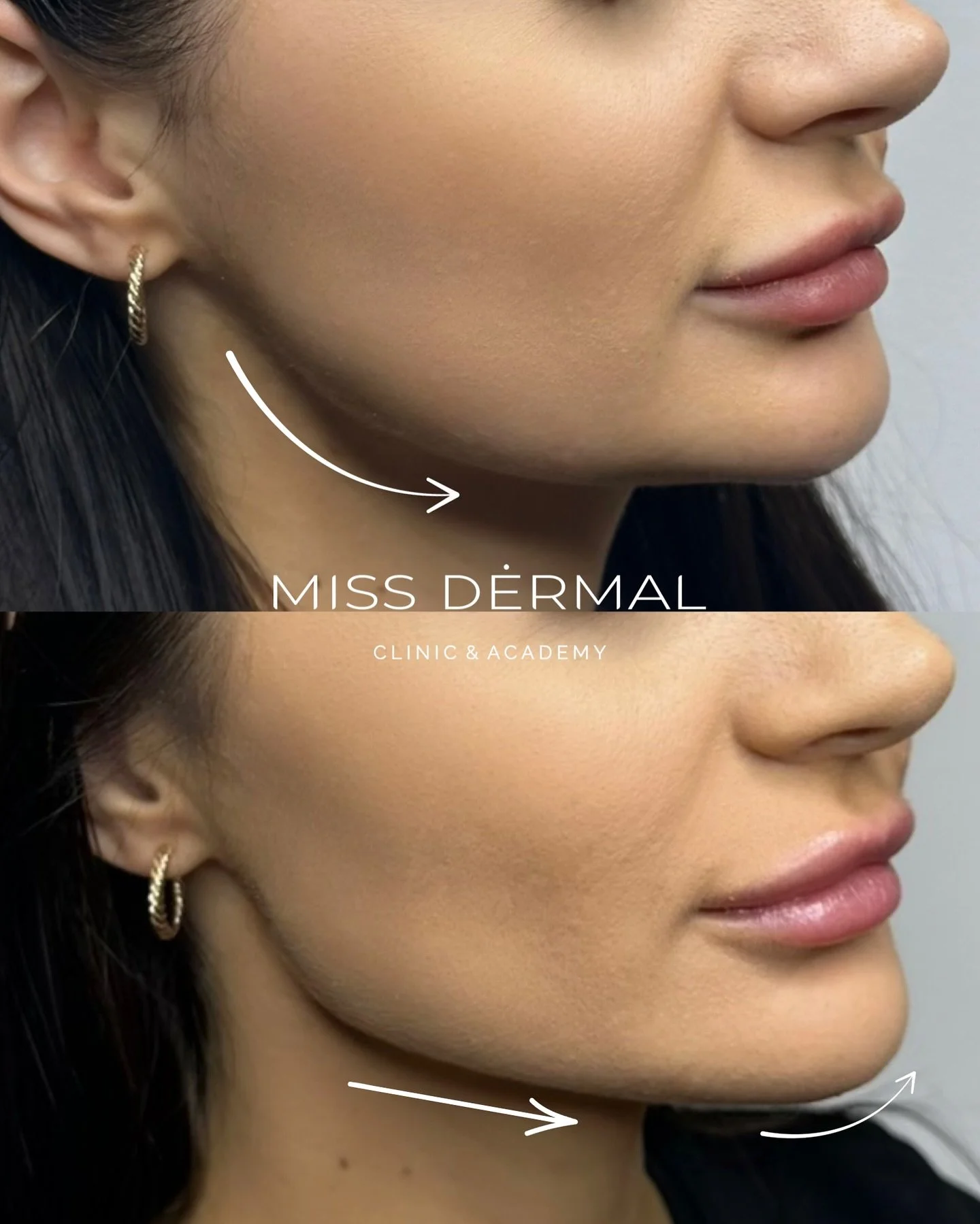 Jawline Goals? I&rsquo;ve got you✨

Lower face contouring with HA dermal fillers gives you definition where it matters most:

&bull; Jawline &ndash; crisp, sculpted edges
&bull; Pre-jowl area &ndash; smoothed out hollows for a seamless line
&bull; Ch