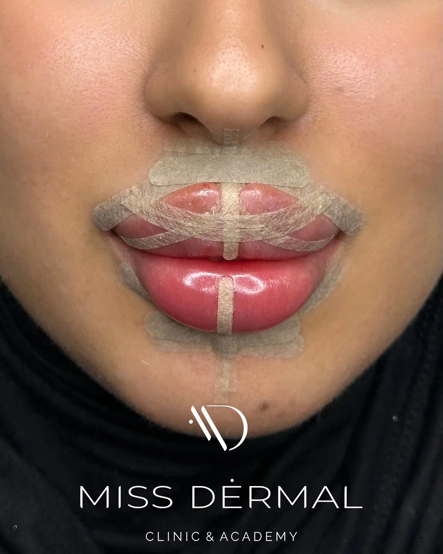 Fusion Lips&trade; &ndash; Dissolve &amp; Refill in One Session 🩹

Say goodbye to migration and hello to refined, balanced lips👄

The Fusion Lips&trade; Technique works by gently dissolving areas of old filler (like lumps or migrated product) and r