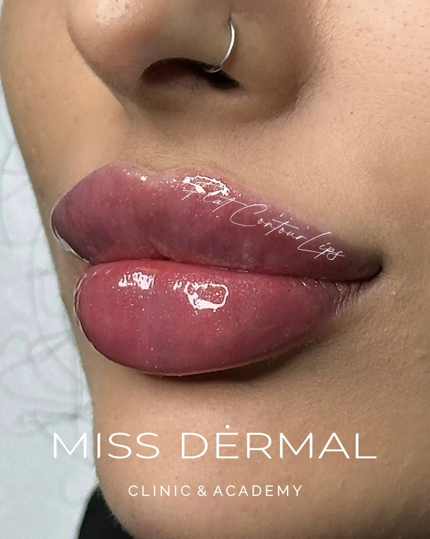 International training, years of hands-on experience, and a very fussy eye for detail&hellip; that&rsquo;s literally my baseline. I&rsquo;m not here to chase trends. I&rsquo;m here to create lips that actually suit your face👄

At Miss Dermal, lips a