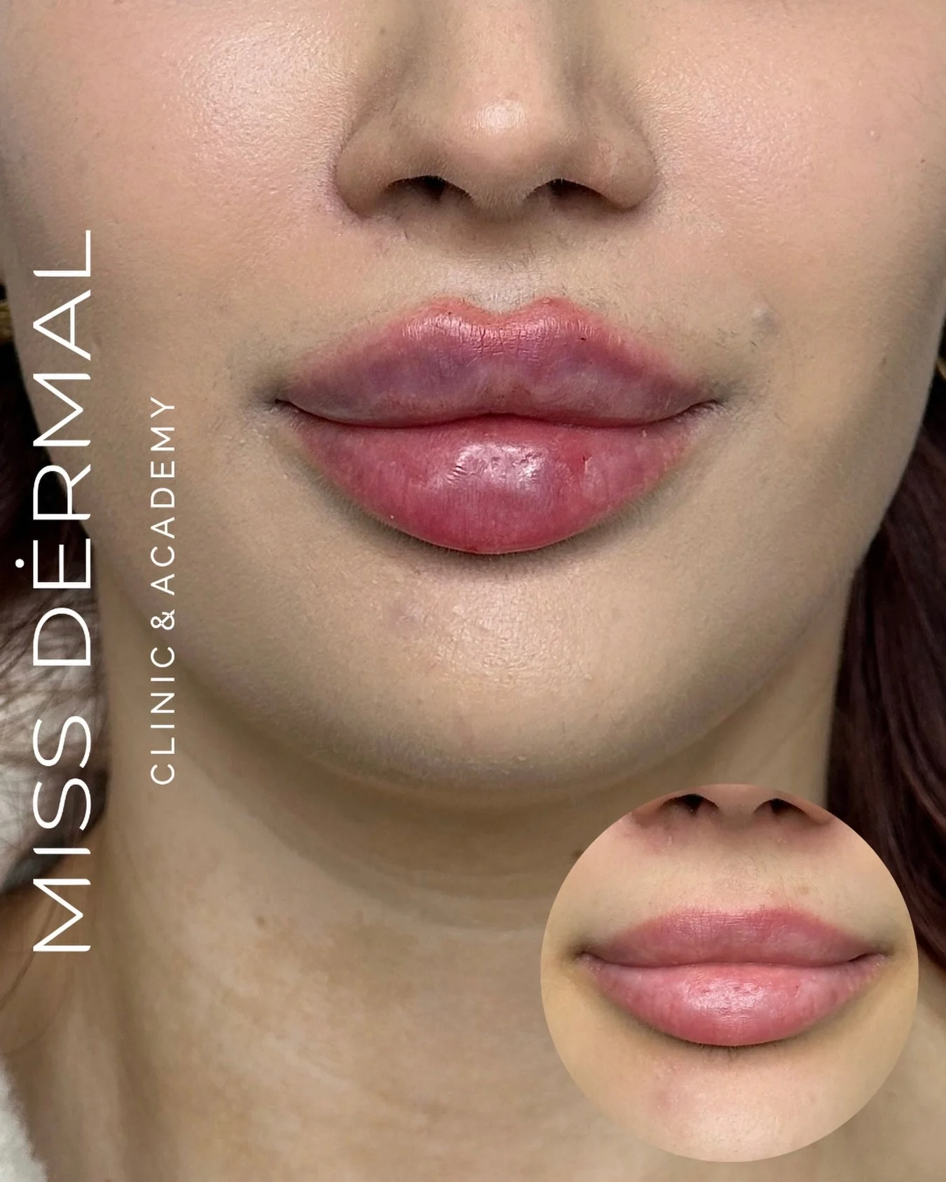 You book &ldquo;just a little bit&rdquo; - then you spend the next week wondering why you waited so long&hellip;

Natural. Balanced. Soft. Beautiful.

No duck lips. No overfilled look. Just expertly placed filler designed to complement your features?