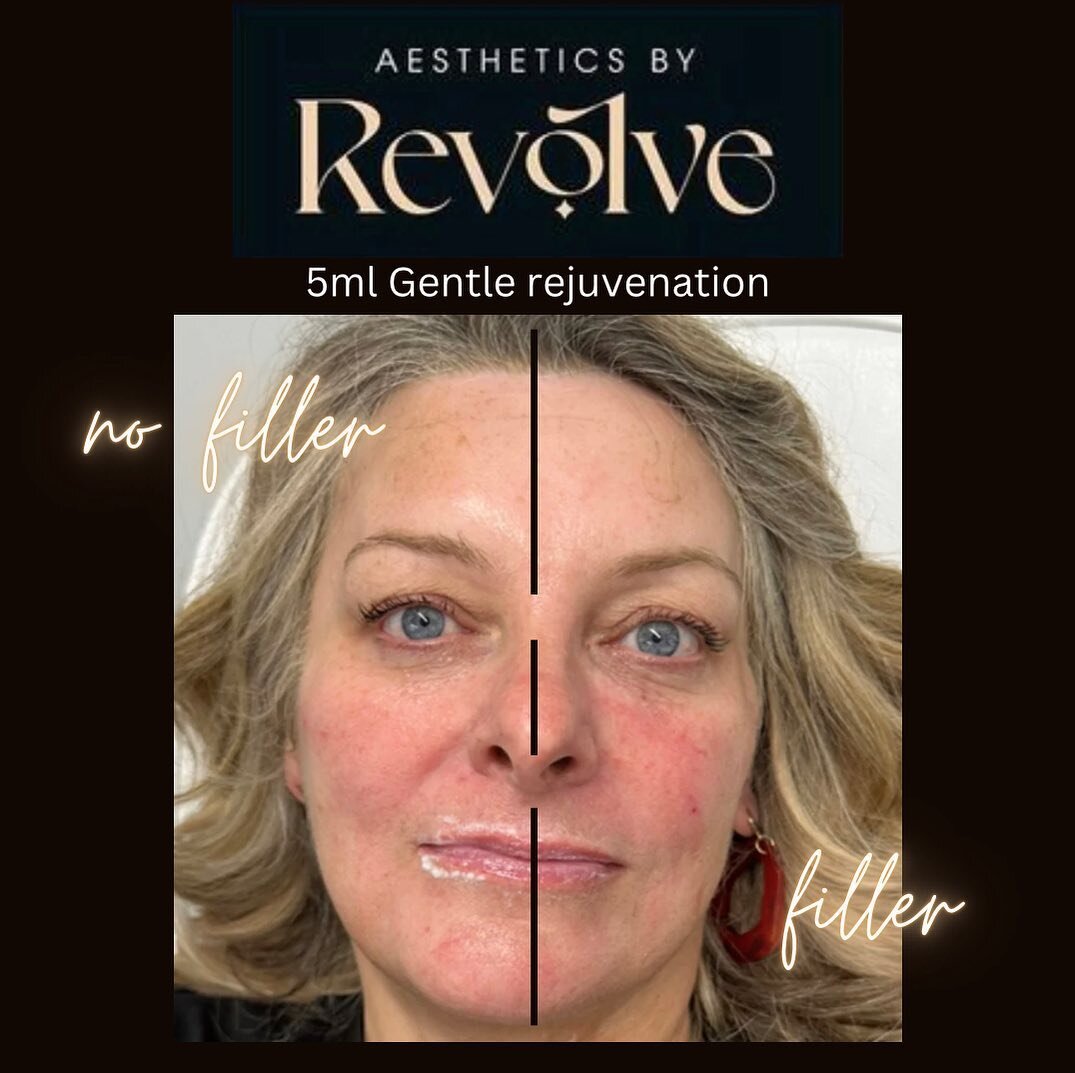 So this gorgeous lady is all the way from Canada and I had the pleasure of doing a gorgeous 5ml face rejuvenation on her here you can see half her face has filler and the other half does not. These packages are amazing for putting volume back in to y