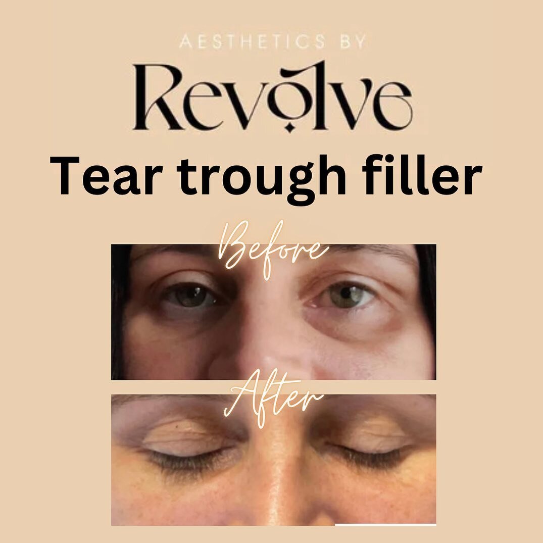 Tear trough filler results! What is tear trough filler? Tear trough fillers are a non-surgical, minimally invasive treatment. It involves numbing the tear trough area with a topical anaesthetic and then injecting the area with hyaluronic acid gel, wh