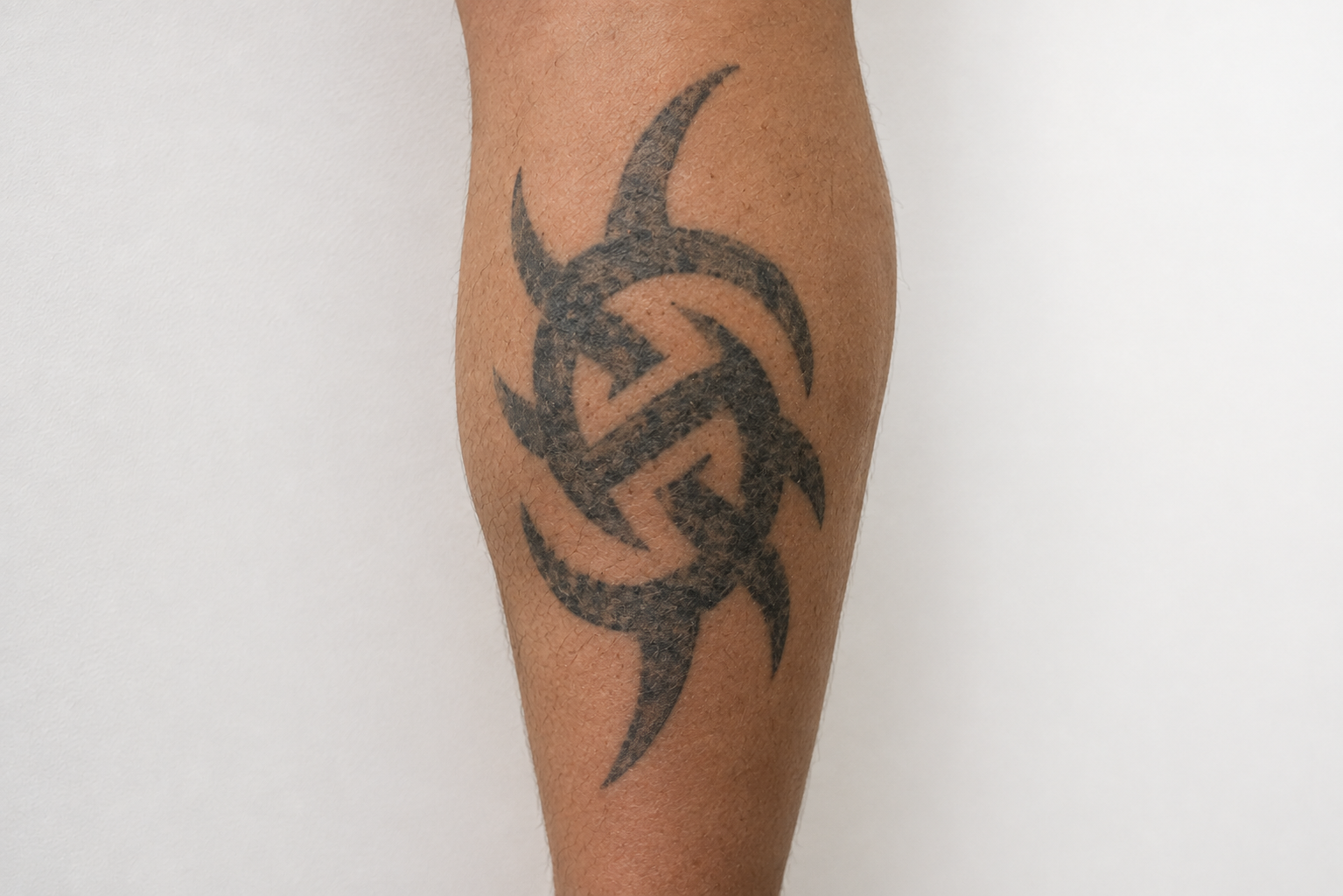 Traditional & Black Ink Tattoo Removal