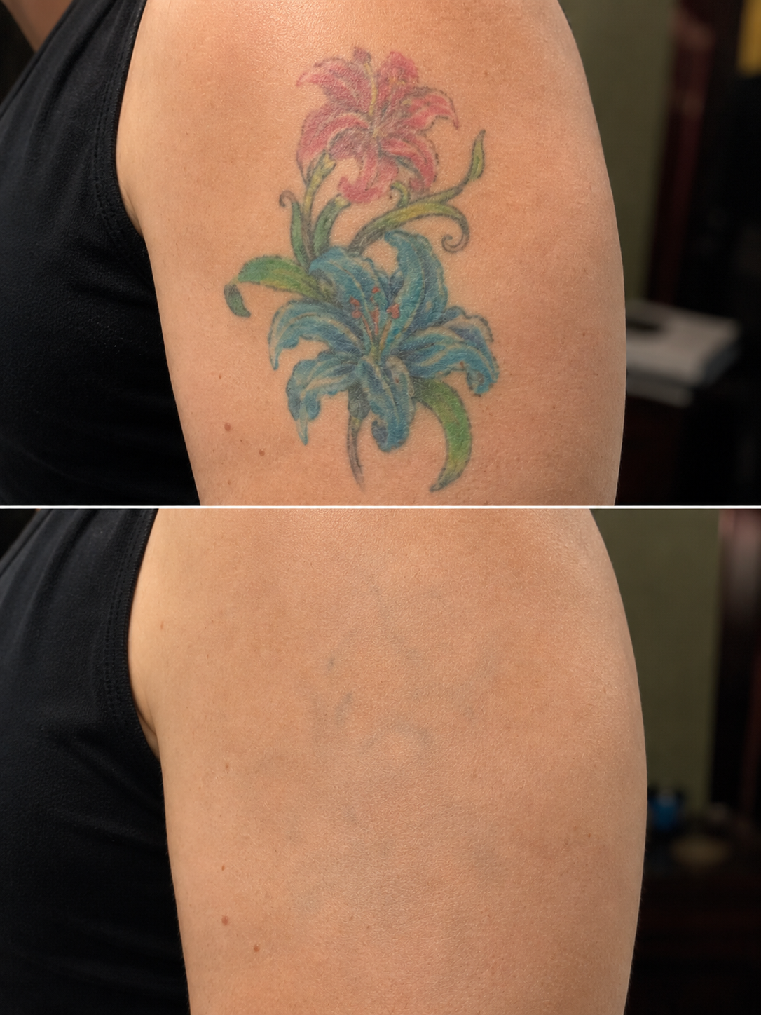 Colour tattoo removal before and after - picosecond laser tattoo removal Vancouver Island at Amendermis