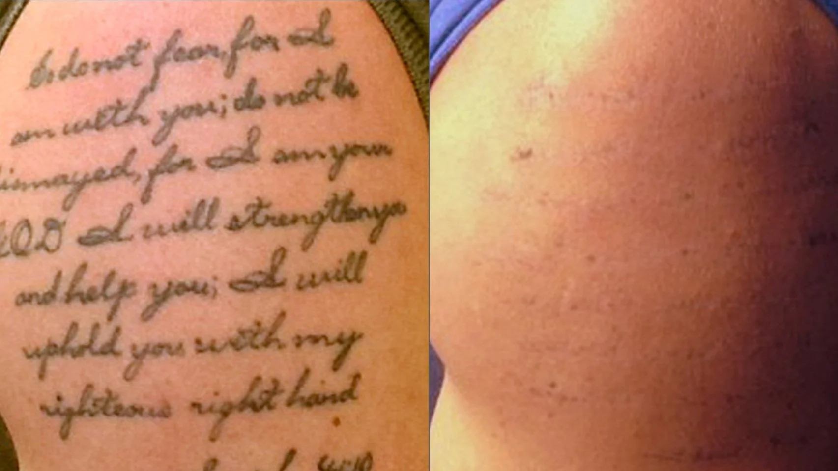 Before and after black tattoo removal with picosecond laser at Amendermis.
