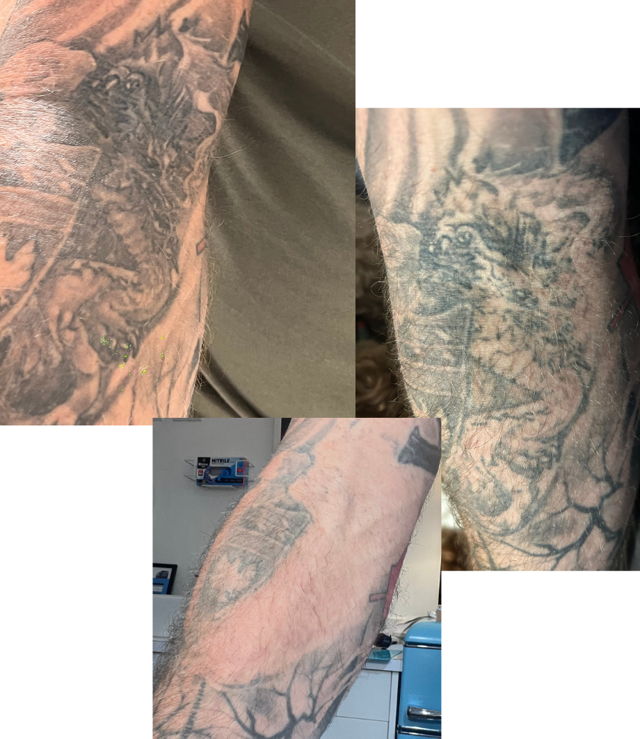 Black tattoo removal before and after - PicoSure laser tattoo removal Vancouver Island at Amendermis