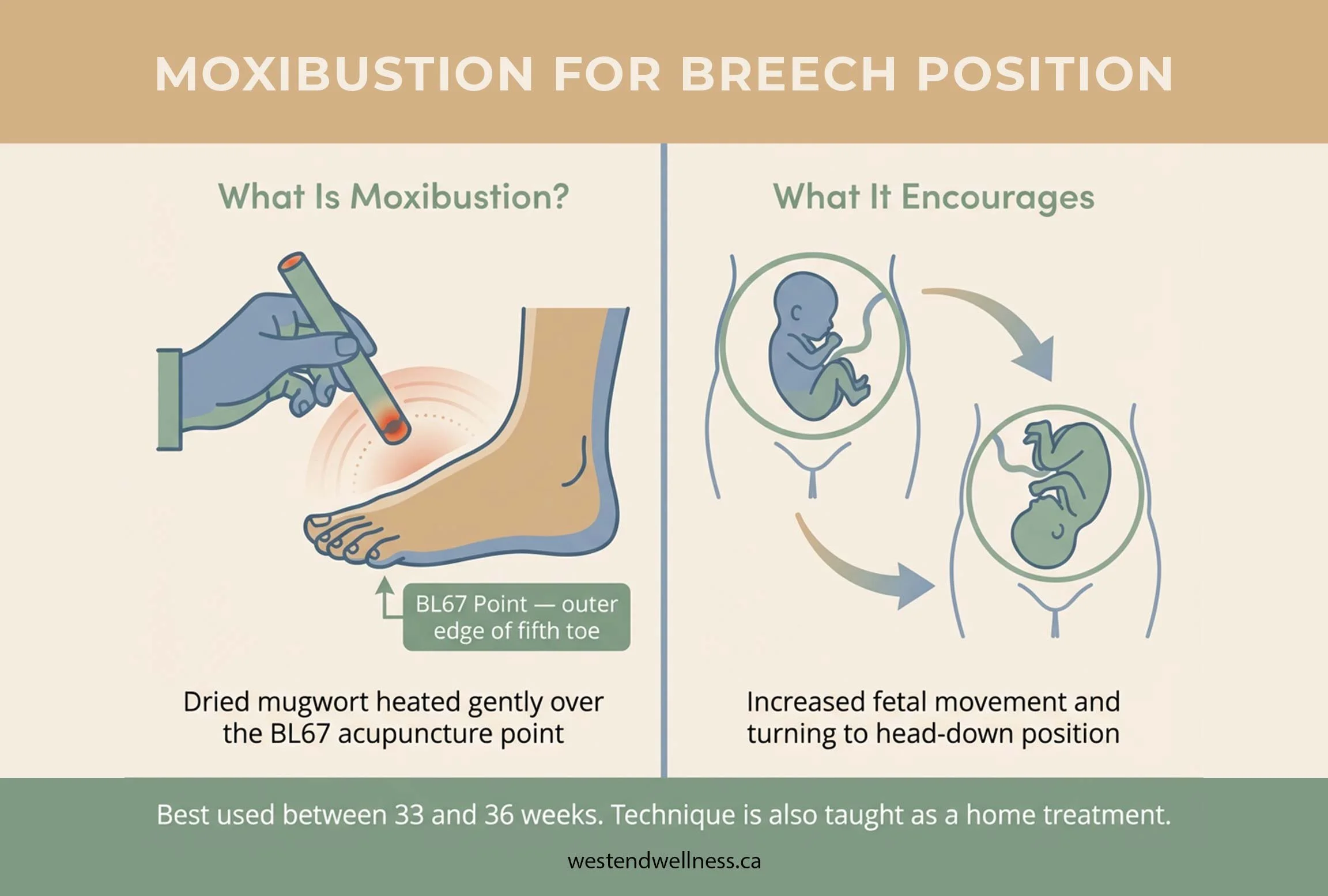 How moxibustion at the BL67 acupuncture point on the fifth toe encourages a breech baby to turn to a head-down position