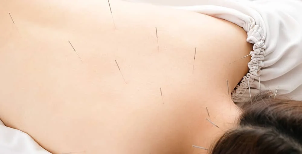 Patient lying face down with multiple acupuncture needles in the back during a treatment session.