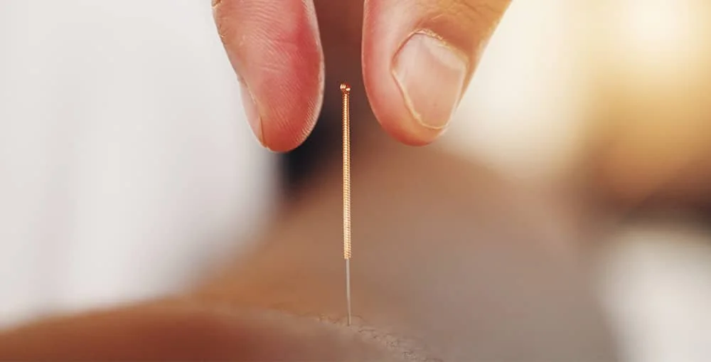 Hand placing acupuncture needle into skin, showing individualized acupuncture care based on personal needs.