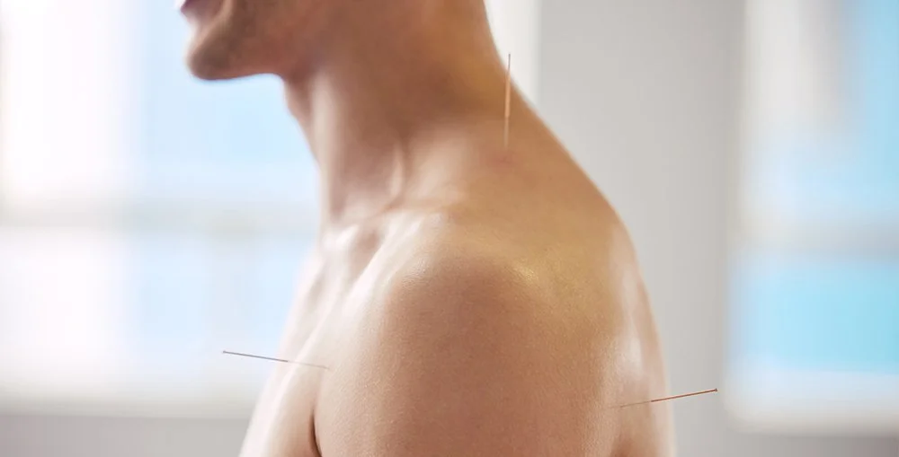 Close-up of practitioner placing acupuncture needle into skin to illustrate precision and therapeutic care at West End Wellness."