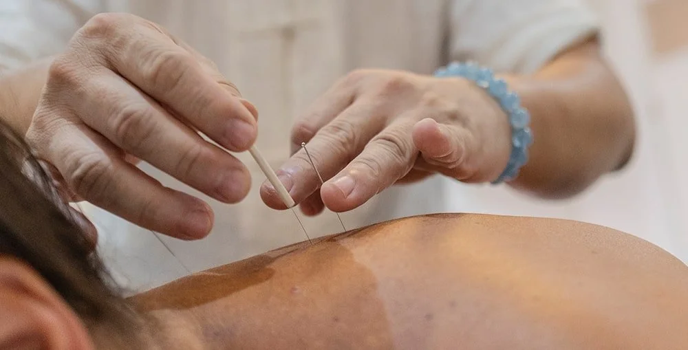 Close-up of acupuncturist inserting needle near patient’s neck, showing how acupuncture supports relaxation and pain relief at West End Wellness Vancouver.