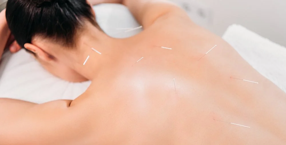 Patient lying face down with acupuncture needles across back, demonstrating visible signs of acupuncture treatment in progress.