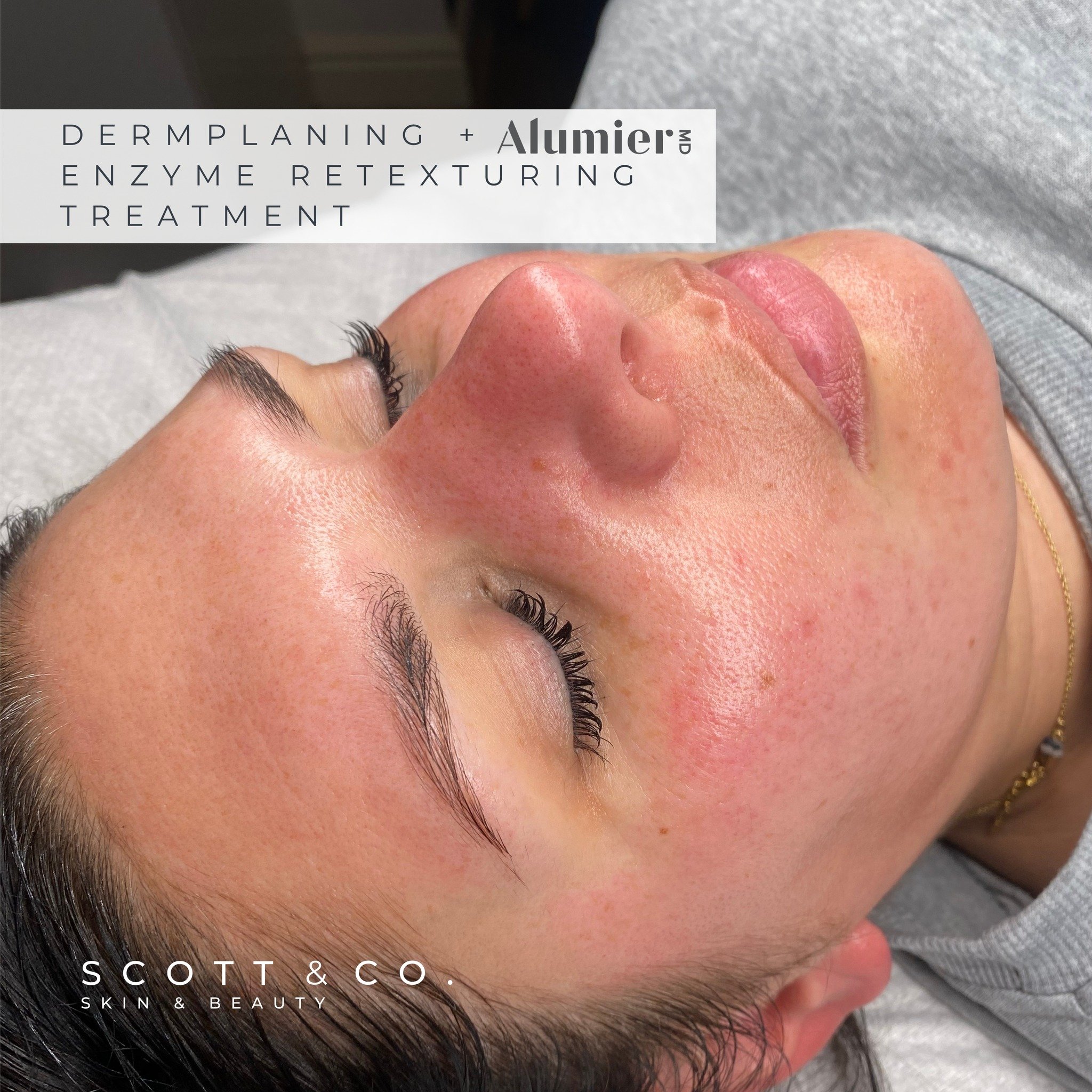 My all time favorite treatment for an instant Glow Up ✨
(Lash Lift &amp; Brows also by me) 

Dermaplaning provides a physical exfoliation removing dead skin cells &amp; vellus hair (aka peach fuzz) from the skins surface. This leaves the skin perfect