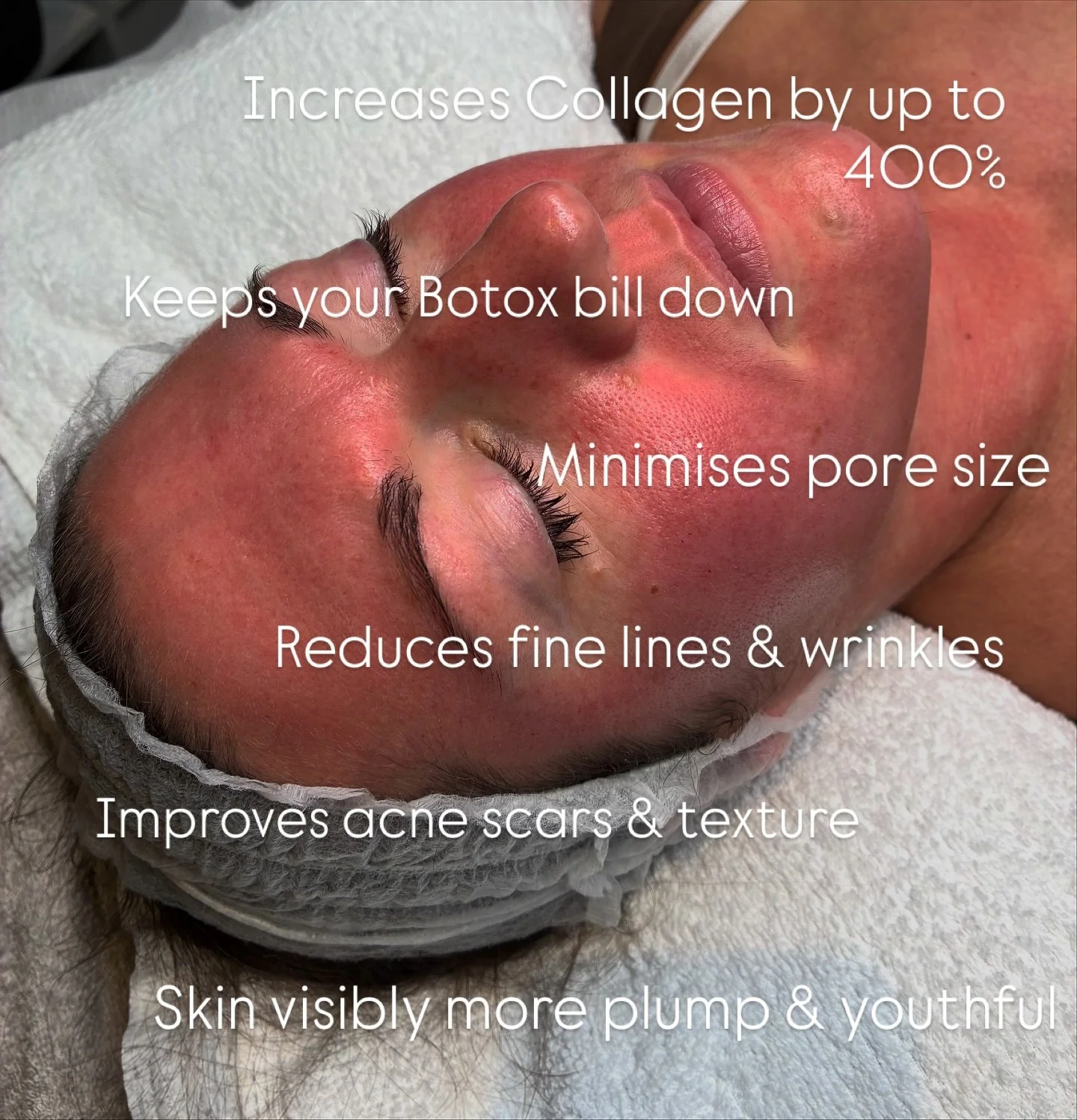 When it comes to collagen production, SkinPen Microneedling has you covered 💙
Clinical studies show that microneedling can boost collagen production by up to 400% after a course of just three treatments, with 94% of clients noticing a reduction in