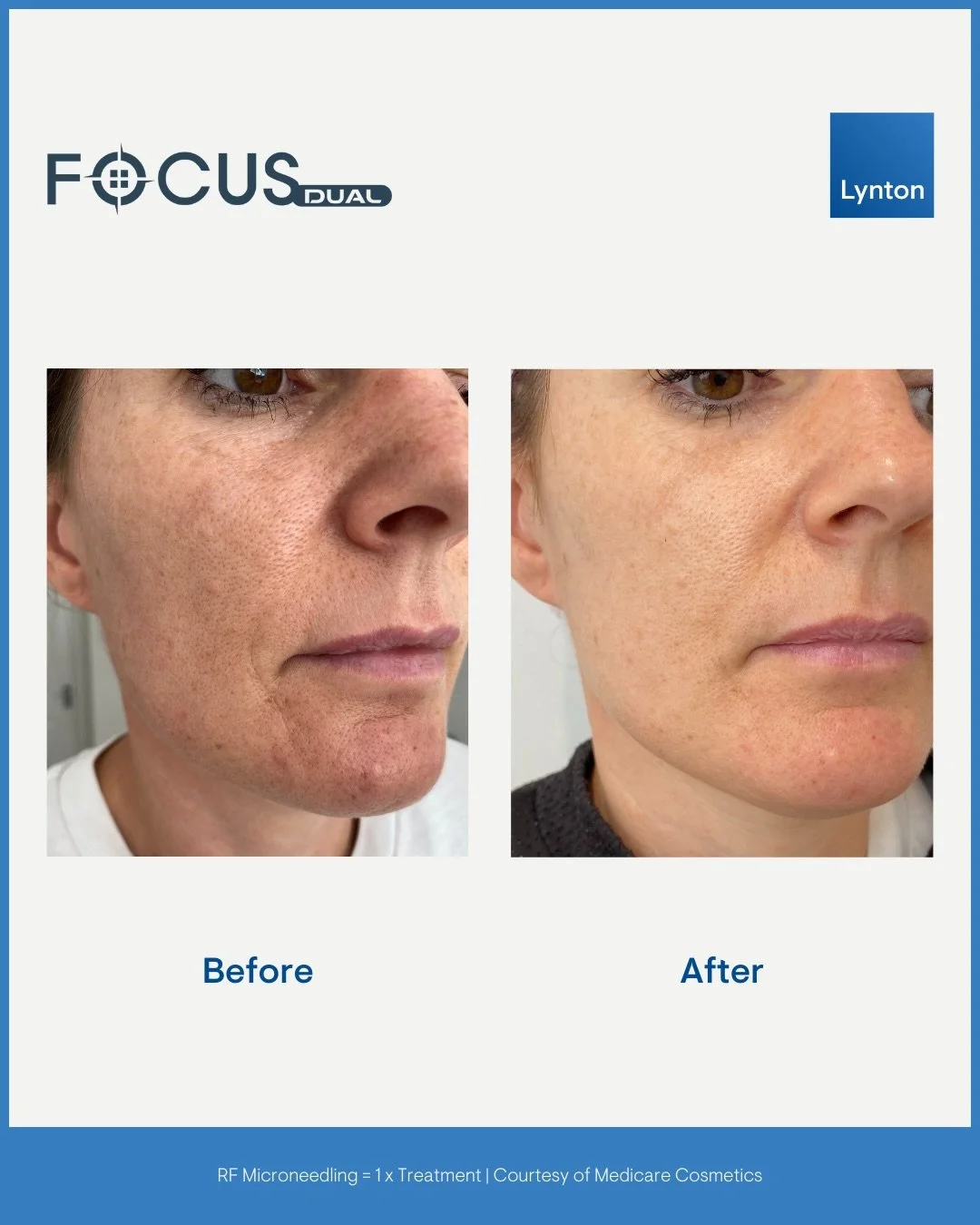 Focus Dual Q&amp;A: 

Q. Who is the treatment suitable for?
A. This treatment is ideal for many people from their early thirties onwards who are beginning to notice the first signs of aging. These changes are often caused by sun damage, genetics, and