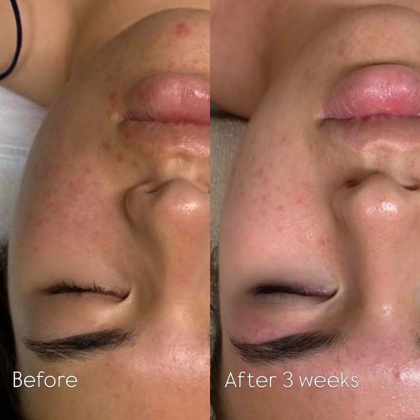 Skin doesn&rsquo;t change overnight&hellip; and that&rsquo;s okay. 🤍

These results were achieved with a course of 6 Dermalux LED treatments over 3 weeks, alongside the introduction of one AlumierMD homecare product.

The improvements here aren&rsqu