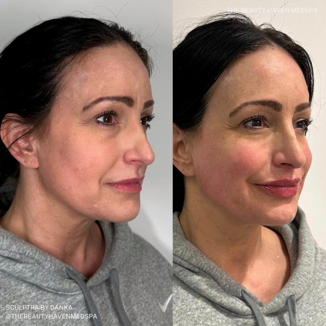Sculptra for Collagen & Volume - The Beauty Haven Med Spa Pittsburgh ...