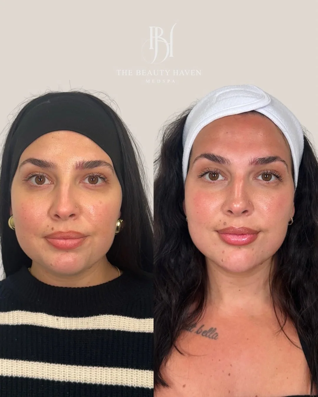 The lower face does a lot of quiet work and when the chin is off, everything around it feels it.

This patient came in wanting more definition and balance in her lower face. Danka addressed the chin and chin shadow adding projection where it was lack