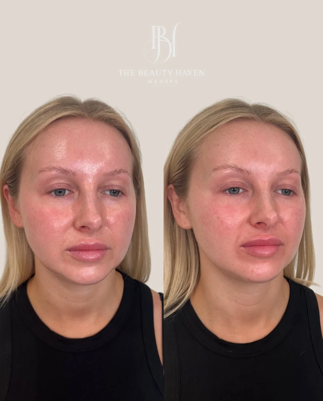 This is what rejuvenated, brightened under-eyes actually look like. 💉

The tear trough is one of the most transformative areas we treat, but also one of the most misunderstood. That hollow, shadowed space between the lower eyelid and the cheek isn&r
