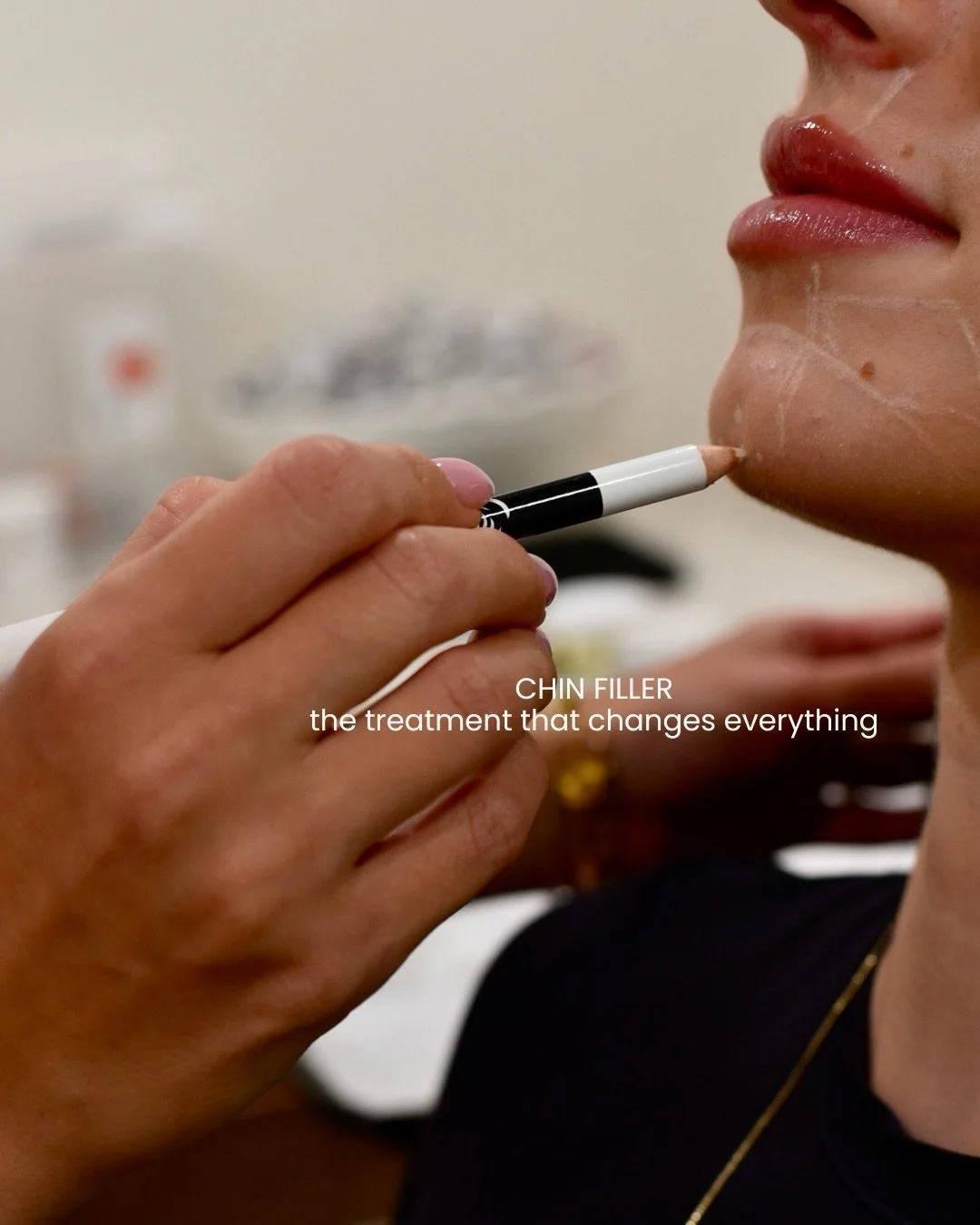 Chin filler is the treatment people overlook and the one they wish they had done sooner. Every single time. 💉

The chin anchors the entire lower face. When it lacks projection or definition it creates a ripple effect the jawline softens, the lips lo