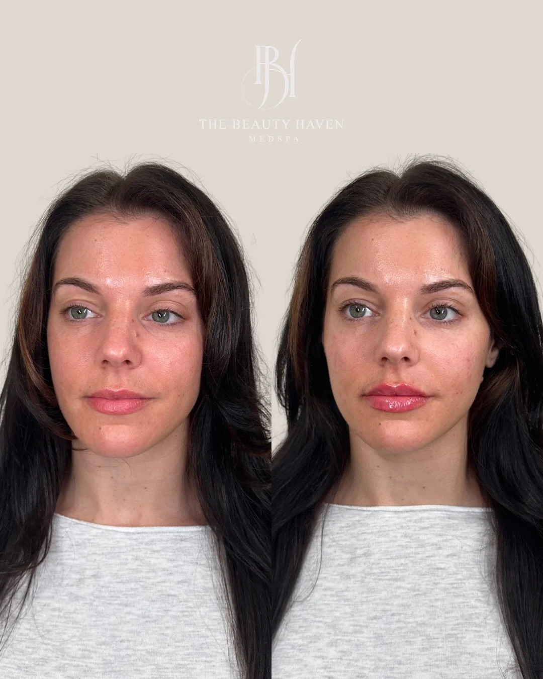 Cheeks and lips 👄 

Subtle volume. Better structure. A little more definition where it matters. Nothing that announces itself, everything that makes you look like the best version of yourself when you walk into a room.

This is the kind of work that