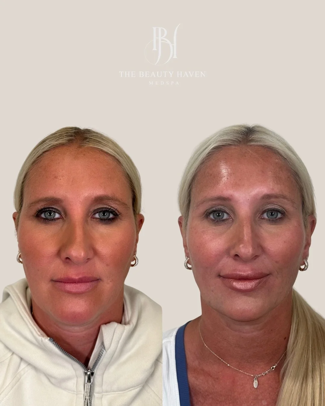 This is what a full plan looks like when every single layer is addressed. 💉

This result didn&rsquo;t come from one treatment or one appointment. It came from looking at this face completely structure, volume, movement, surface and building a strate
