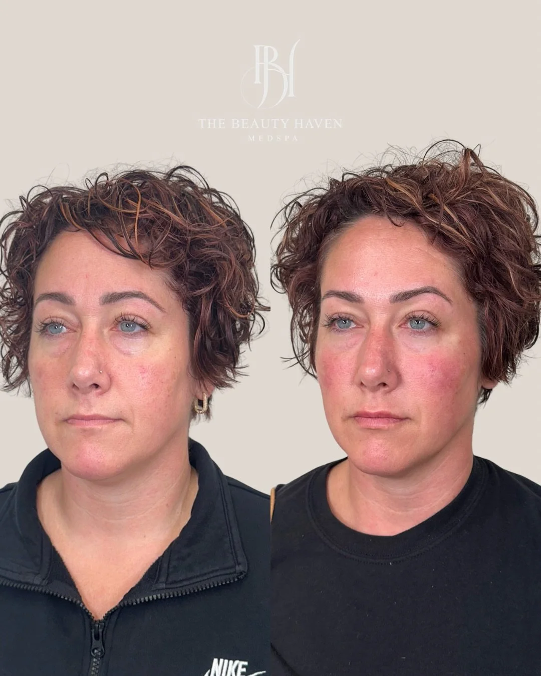 Two sessions. Every detail intentional. This is what patience looks like when it pays off. 💉

This result wasn&rsquo;t rushed. It was built carefully, strategically, and in the right order across two appointments that each had a clear purpose.

Sess
