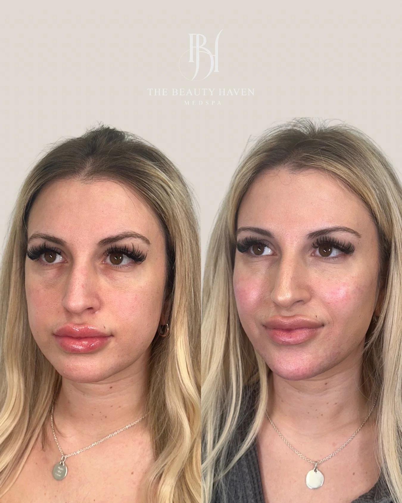 Structure first. Everything else follows. 💉

This result came from addressing the three areas that define how a face holds together cheeks, chin, and the muscle activity working against both of them.

Cheek filler to rebuild the foundation. When mid