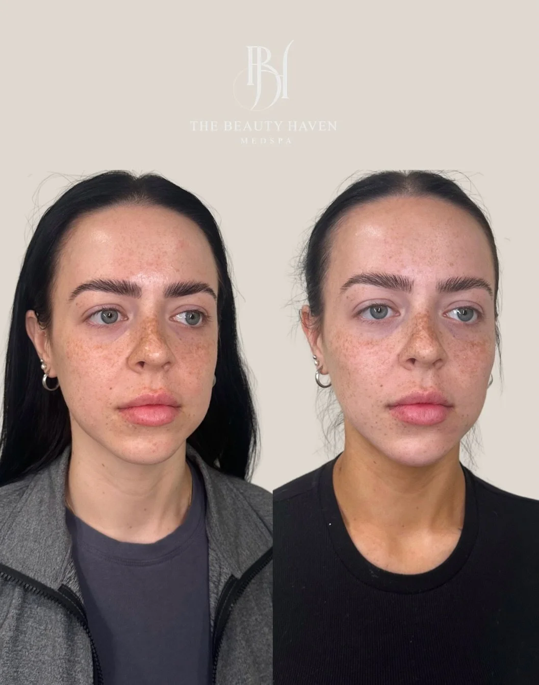 What you&rsquo;re looking at is a result that&rsquo;s still in progress and it&rsquo;s already this good.

Here&rsquo;s where we started. Tox to relax movement, protect every placement, and prevent lines from deepening further. Lips to balance the to
